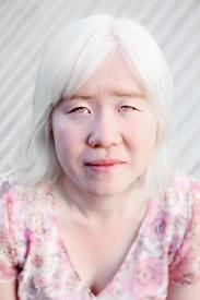 A Lady with albinism